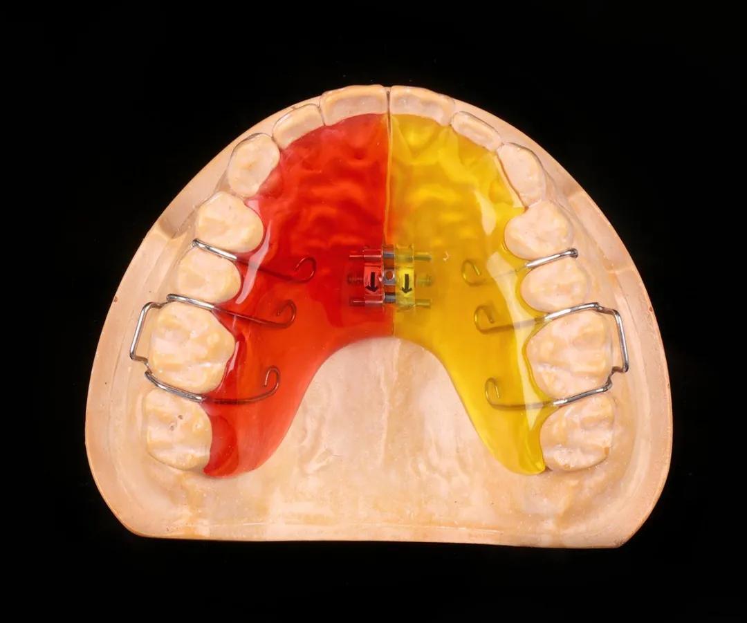 扩弓器是让牙弓扩大的一个辅助工具,主要作用就是调节牙弓的大小,让