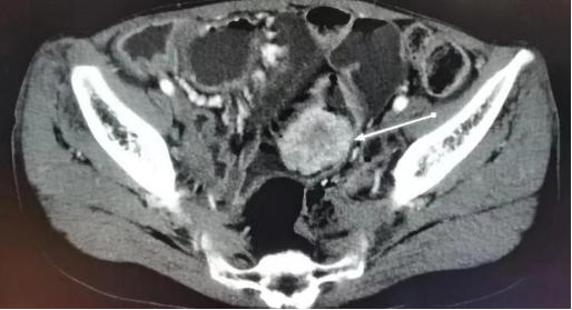 手术拉链怎么拆30多年4次开腹，上海医生让“拉链腹”患者告别多年肠套叠_https://www.jmylbn.com_新闻资讯_第2张