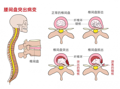 腰椎间盘膨出了，吃舒筋健腰丸有效果吗？_凤凰网区域_凤凰网