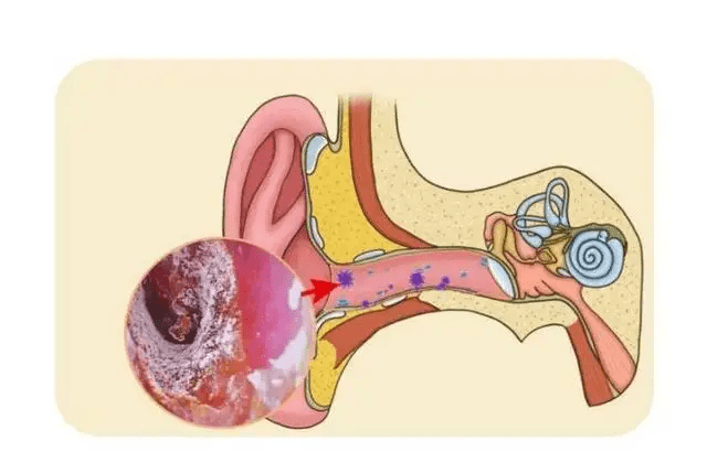 外耳道新生物图片图片