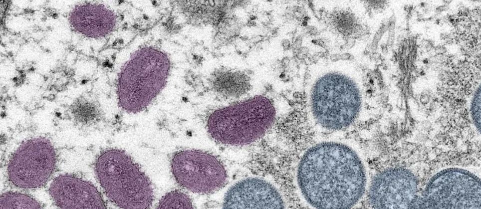 猴痘是一种病毒性人畜共患病，其症状与过去在天花患者中看到的症状非常相似。图片来源：美国CDC/Cynthia S. GoldsmithRussell Regnery
