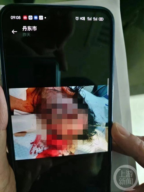 ▲萱萱头部伤口触目惊心。 图片来源/受访者供图