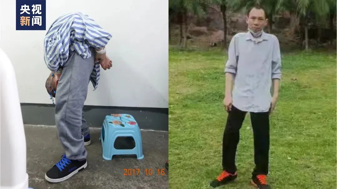 施胜平,术后恢复身高1.56米,目前在深圳工作。