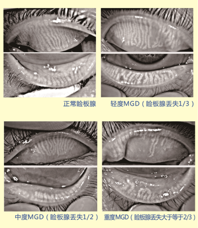 眼睑腺缺失图片