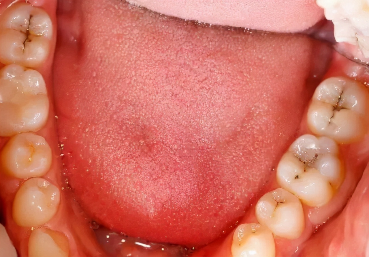 一般情况下健康的牙齿是呈淡黄色,整体通透有光泽,没有其他黑线黑点的