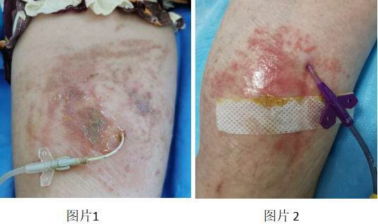 炎炎夏日如何应对picc导管周围皮肤湿疹