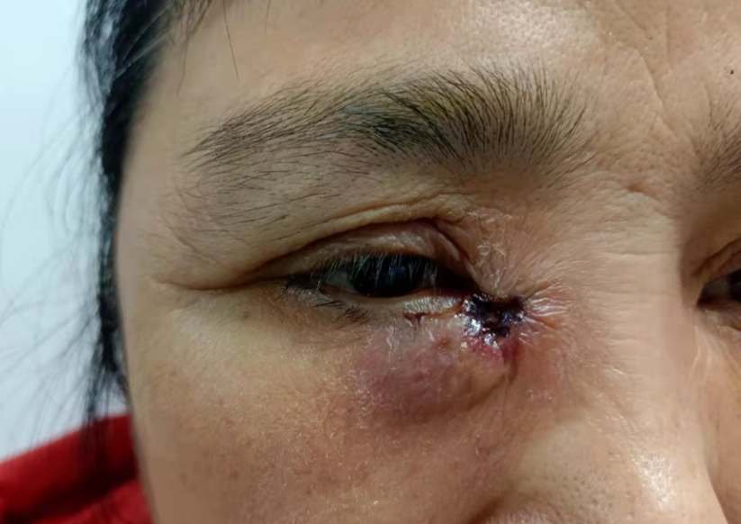 50岁阿姨眼睛肿成"馒头",急性泪囊炎原来这么可怕?__凤凰网