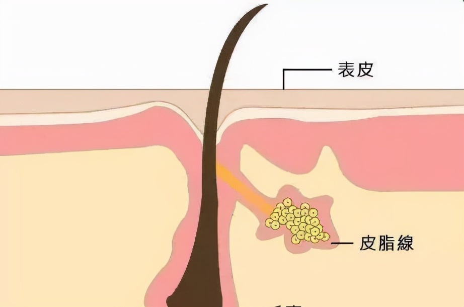 她鼻背两旁的小疙瘩到底是啥