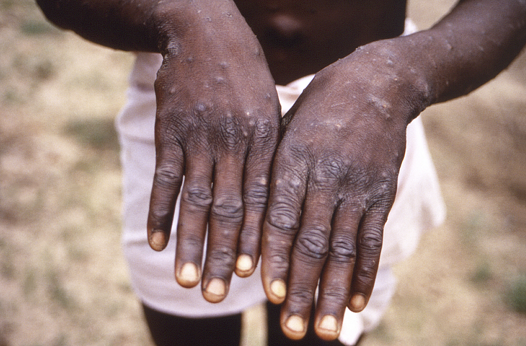 果共和国，美国疾病控制与预防中心提供的图像显示一位猴痘患者手部。  视觉中国 图 