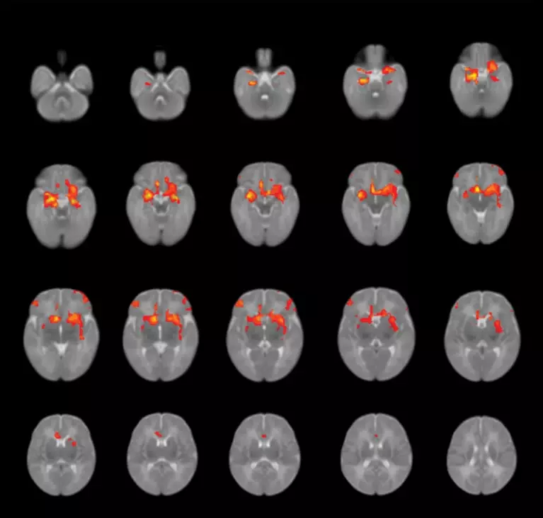 英国大部分孩子都“阳”过了 真正最严重的影响是什么?
