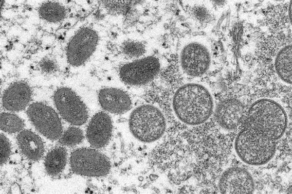 英国病例翻倍增长！多国报告出现的猴痘是什么疾病？