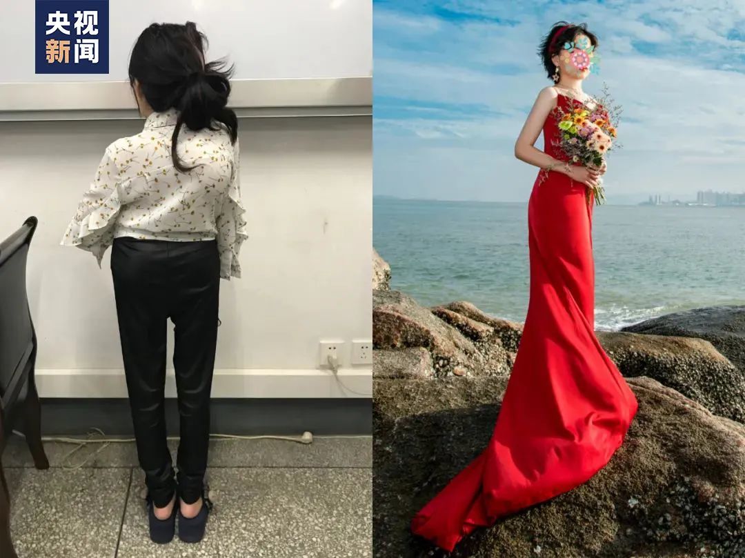 夏天(化名),术后增高21厘米,术后一年结婚,目前是一名社区工作者。