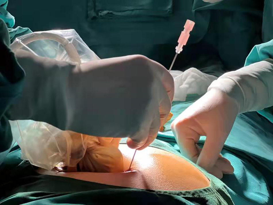在子宫内做心脏手术上海多学科专家为先心病胎儿创造生机