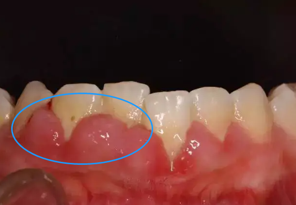 牙龈位置图片图片