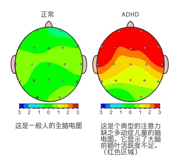 儿童多动症(ADHD)和肠道菌群失调有关,益生菌可以治疗多动症!_凤凰网
