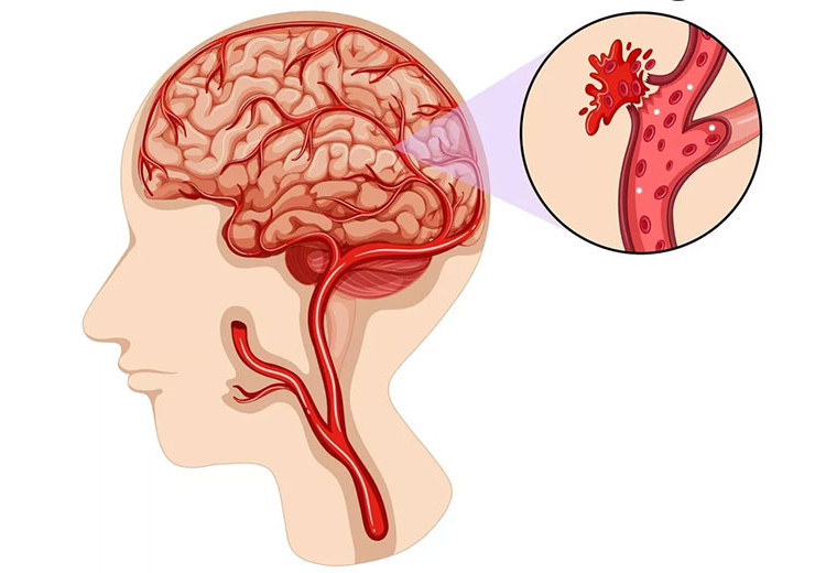 脑出血是怎么引起的图片