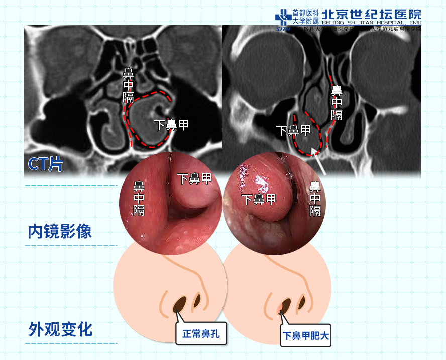 走進鼻子系列——治療鼻炎之後策 手術篇__鳳凰網