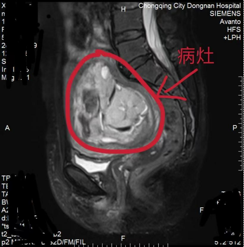 葡萄胎图片（葡萄胎图片 原图） 第1张