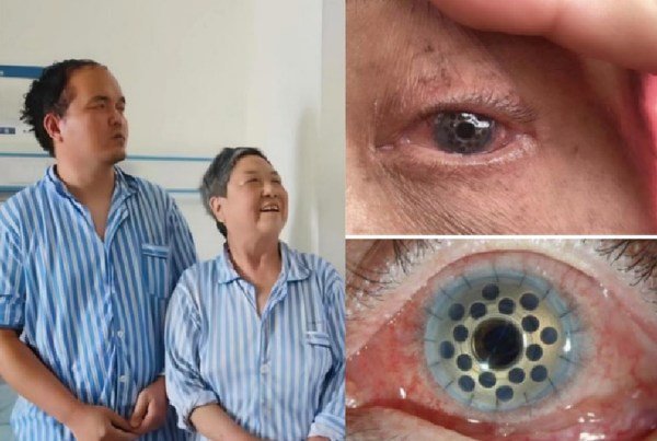 国产领扣型人工角膜手术在各重点医院开展为角膜盲患者带来希望