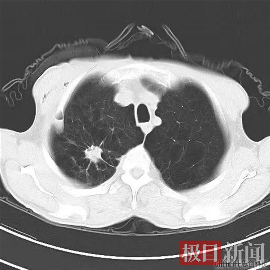 兩毫米小孔入胸這根針讓肺癌灰飛煙滅