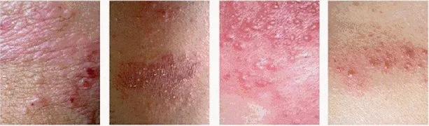 玫瑰糠疹和体癣的区别图片