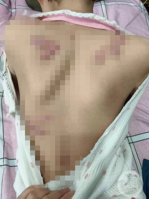 ▲萱萱身体上的伤疤,面积较大。 图片来源/受访者供图