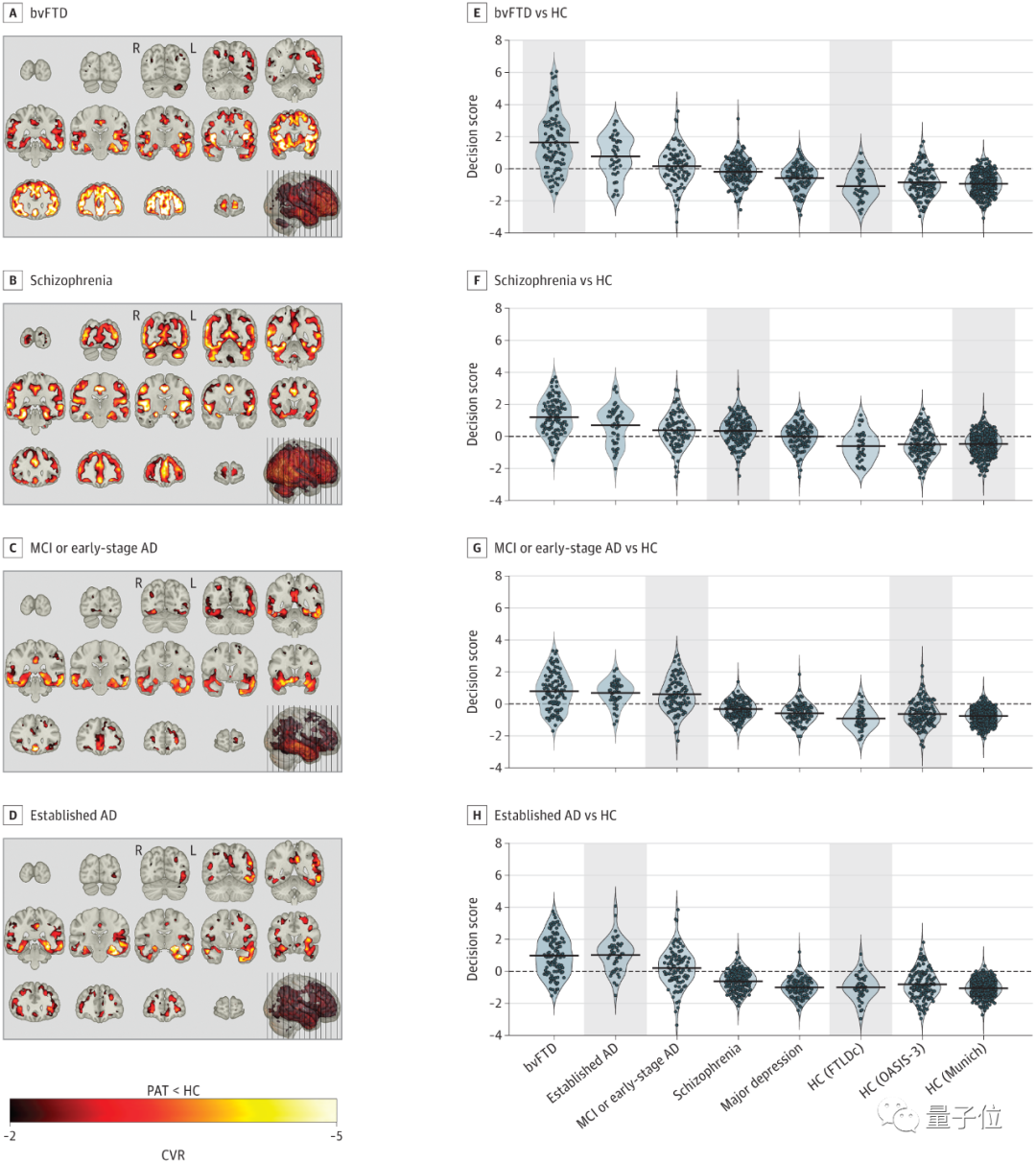 科学家用ML证明120年前争议理论:精神分裂与痴呆症存在相似之处