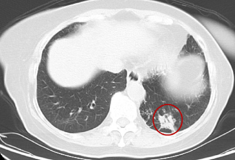 八旬老人肺部长鹌鹑蛋大肿瘤,微创手术切除仅留3厘米切口