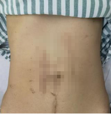 手术拉链怎么拆30多年4次开腹，上海医生让“拉链腹”患者告别多年肠套叠_https://www.jmylbn.com_新闻资讯_第1张