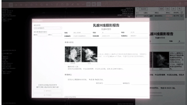 乳腺机是什么GE医疗中国战略再获“硕果”，正式交付第1000台国产智能型乳腺机_https://www.jmylbn.com_新闻资讯_第4张