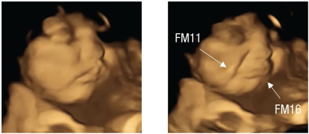 左为正常情况下胎儿的表情,右为羽衣甘蓝组宝宝的哭脸表情。