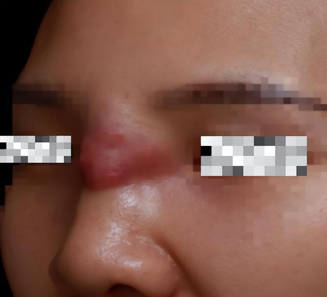 注射部位感染图片