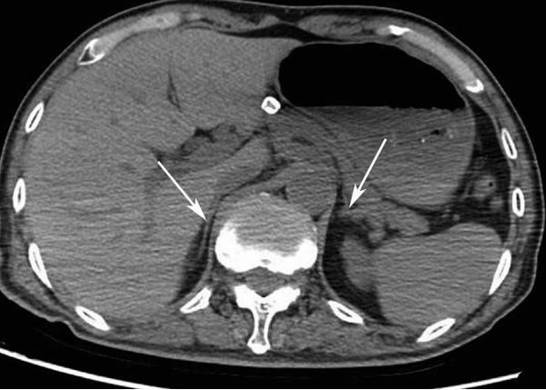 腹部计算机断层成像检查显示双侧肾上腺萎缩 [1]