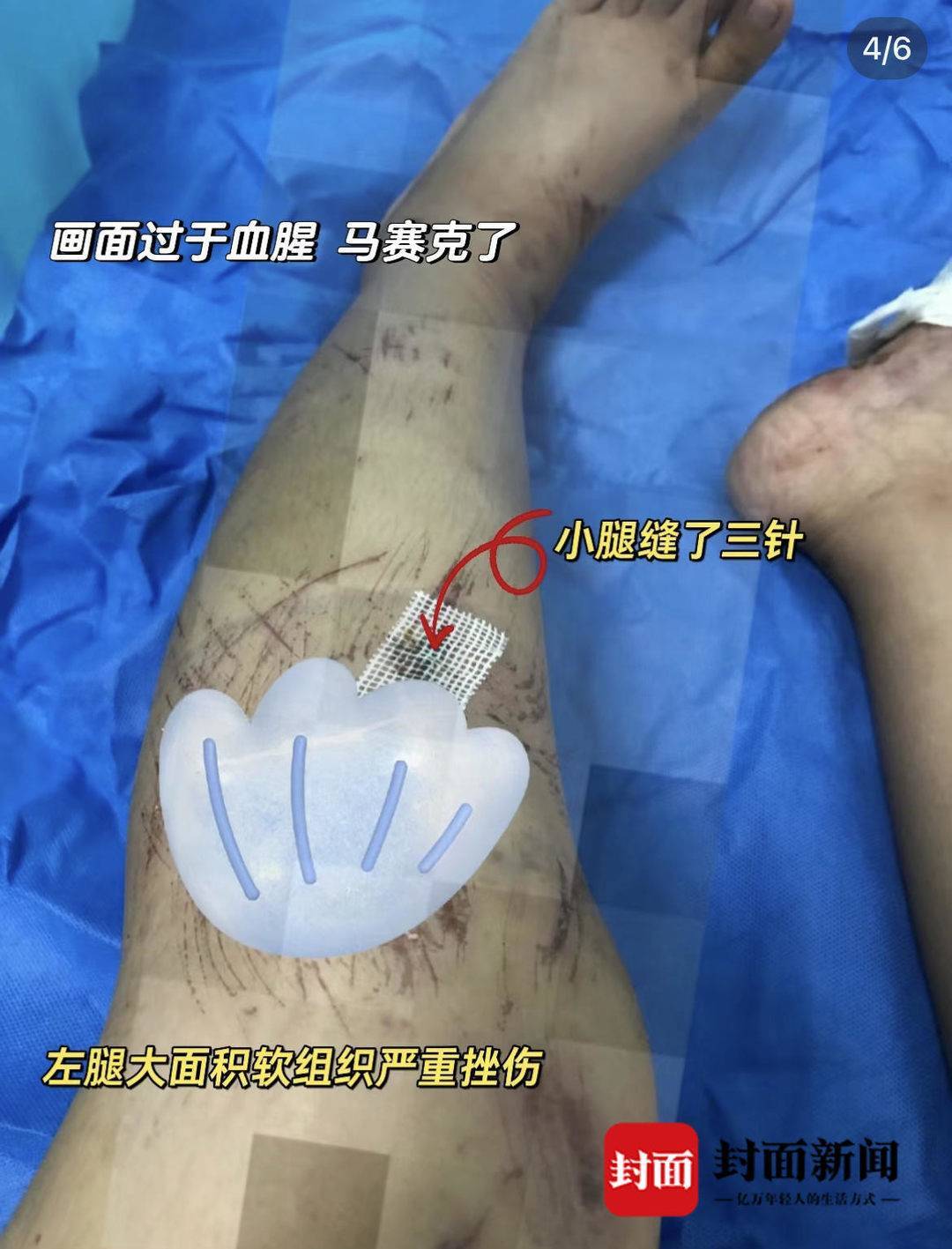 闻女士腿部受伤情况(受访者供图)