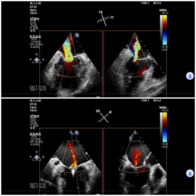 手术前后二尖瓣反流