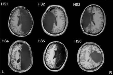 6 名患者的 MRI 图像