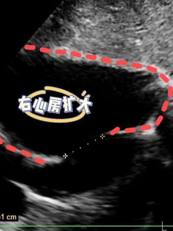 心脏彩超下的右心房扩大