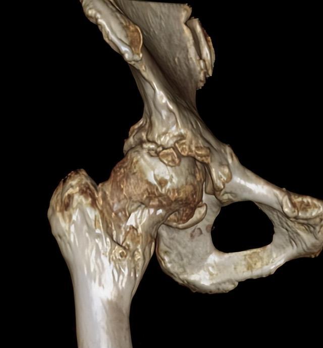 ▲术前影像资料(股骨头塌陷、骨质增生)
