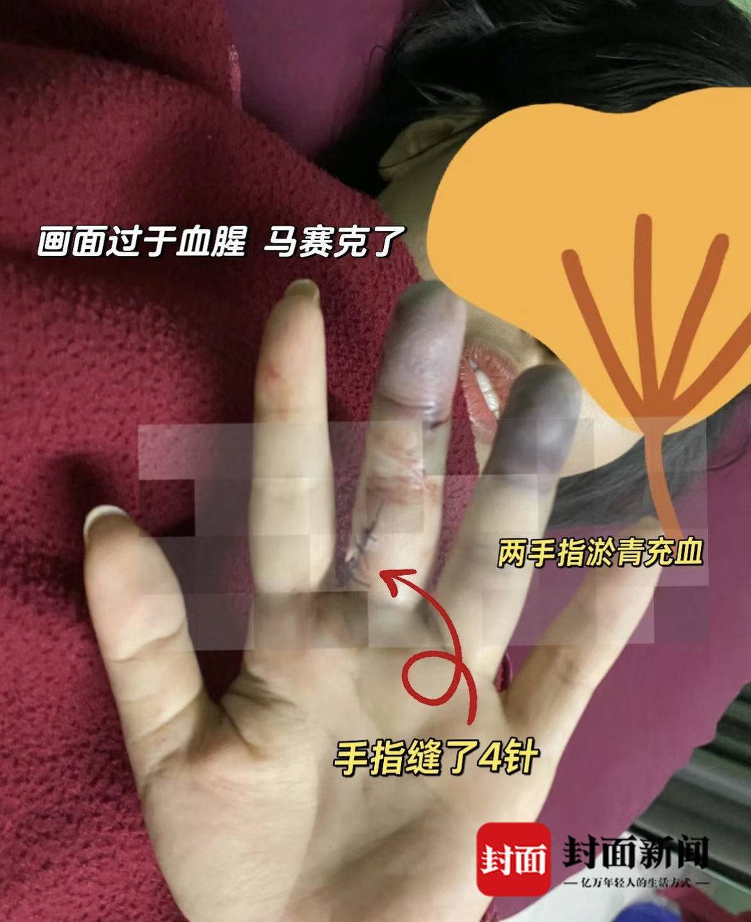 手部受伤情况(受访者供图)