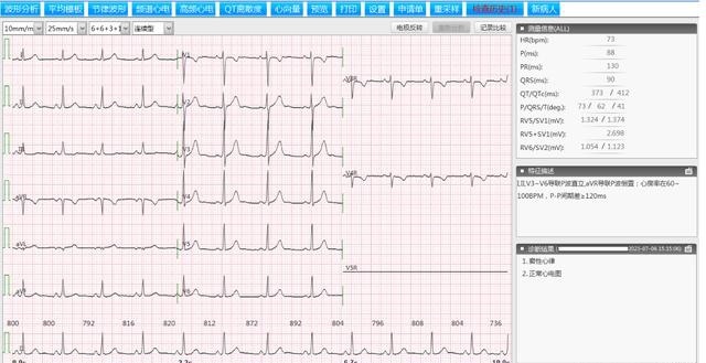 图1 窦性心律(心率73次/分) 正常心电图