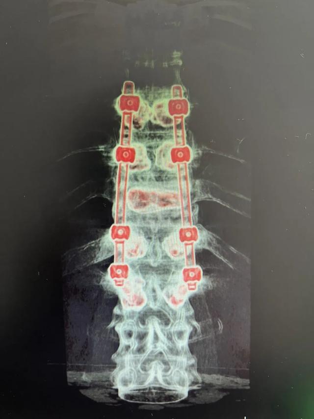 术中、术后影像(8钉2棒)