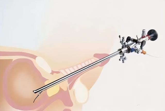 ▲膀胱镜硬镜操作示意图