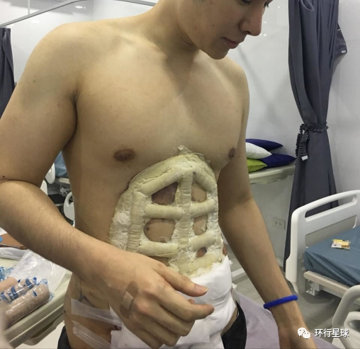 泰国模特Ome Pangpaparn在做腹肌手术，医生在为6块腹肌做规划