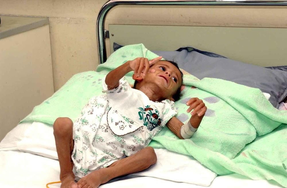2004年9月18日,一名患白血病的伊拉克儿童躺在巴格达儿童医院