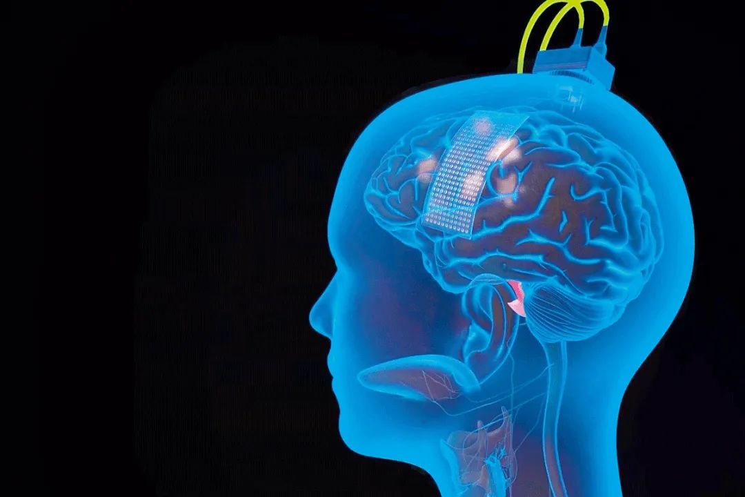 安的大脑表面植入了一个薄薄的矩形电极，以接收其试图说话时发出的信号。图/加州大学