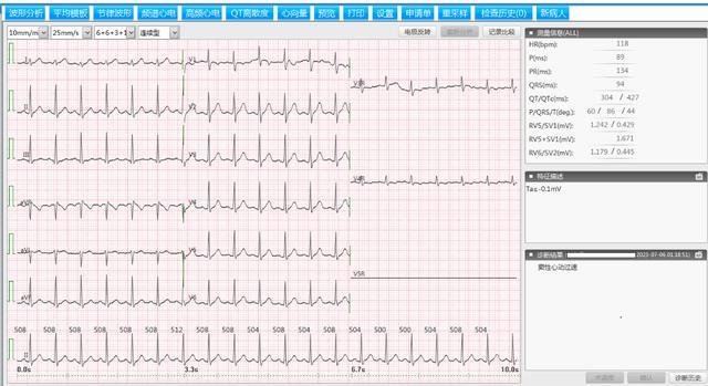 图3 窦性心动过速(心率118次/分)