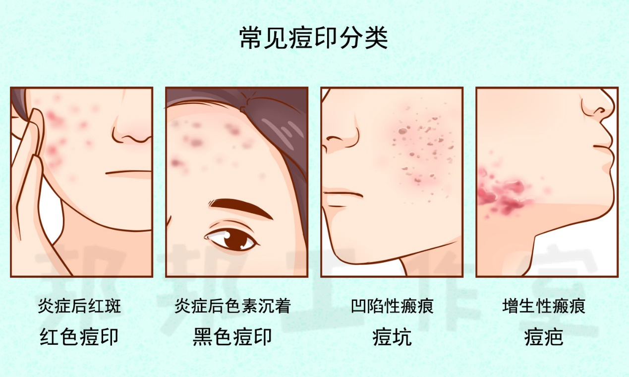 痘印全攻略——不同类型的治疗选择_凤凰网健康_凤凰网