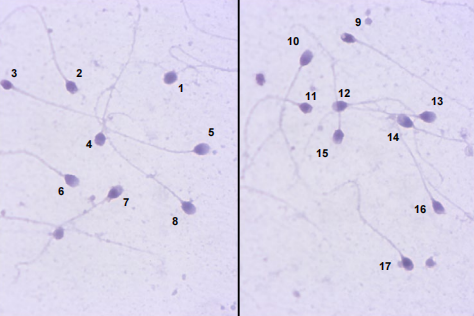 △世卫组织《人类精液检查与处理实验室手册(第6版)》中,研究人员对精子进行统计时记录的画面