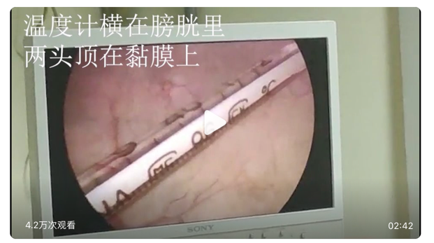 膀胱镜下彩色的磁力珠丨参考文献10