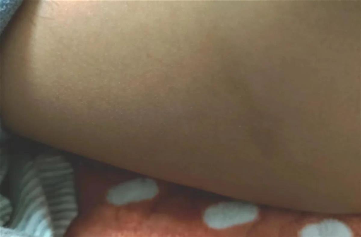 女儿身上的淤青(受访者提供)